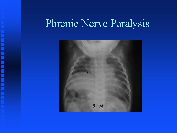 Phrenic Nerve Paralysis 