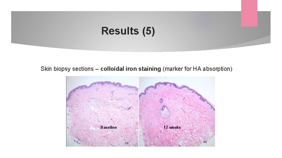 Results (5) Skin biopsy sections – colloidal iron staining (marker for HA absorption) Baseline