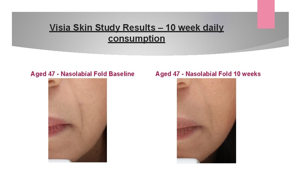 Visia Skin Study Results – 10 week daily consumption Aged 47 - Nasolabial Fold