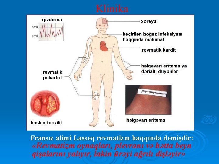 Klinika Fransız alimi Lasseq revmatizm haqqında demişdir: «Revmatizm oynaqları, plevranı və hətta beyn qişalarını