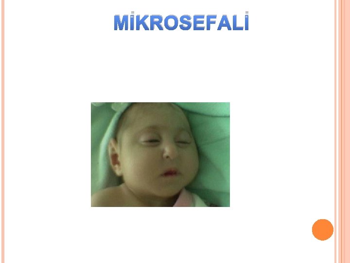 MİKROSEFALİ 