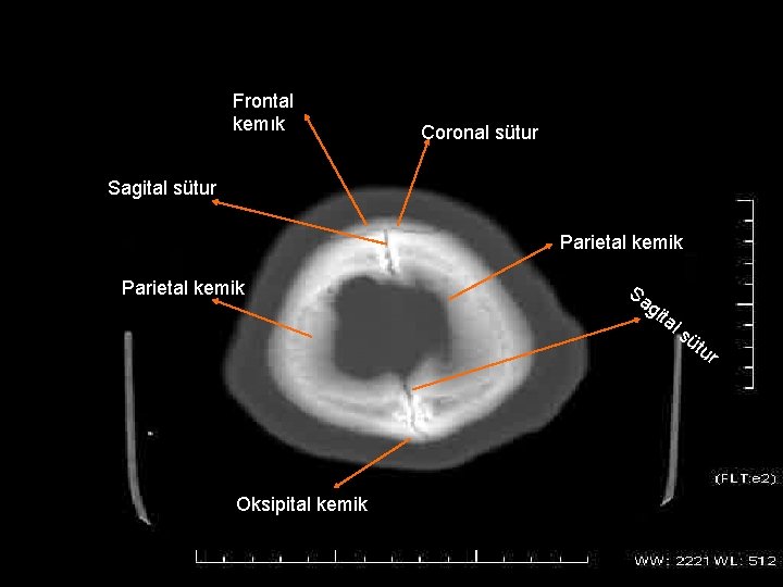 Frontal kemık Coronal sütur Sagital sütur Parietal kemik Sa g ita Oksipital kemik l