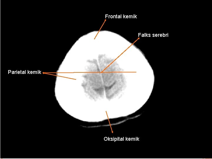 Frontal kemik Falks serebri Parietal kemik Oksipital kemik 