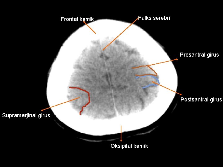 Frontal kemik Falks serebri Presantral girus Postsantral girus Supramarjinal girus Oksipital kemik 