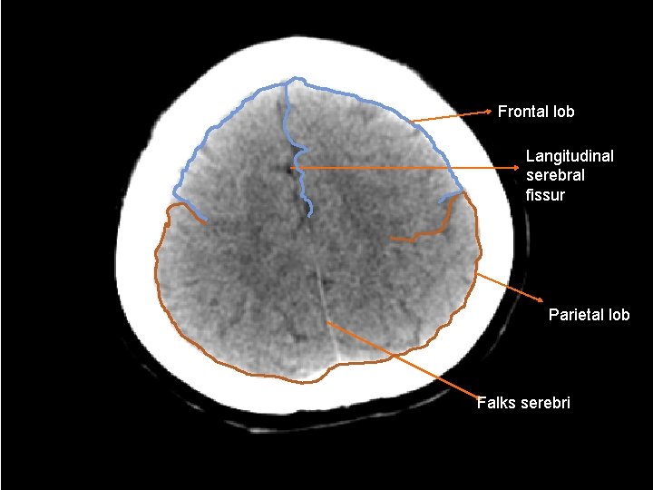 Frontal lob Langitudinal serebral fissur Parietal lob Falks serebri 