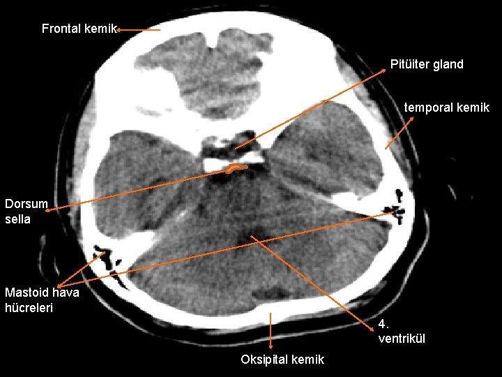 Frontal kemik Pitüiter gland temporal kemik Dorsum sella Mastoid hava hücreleri 4. ventrikül Oksipital