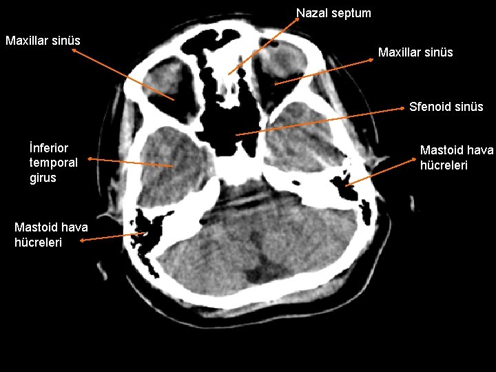 Nazal septum Maxillar sinüs Sfenoid sinüs İnferior temporal girus Mastoid hava hücreleri 