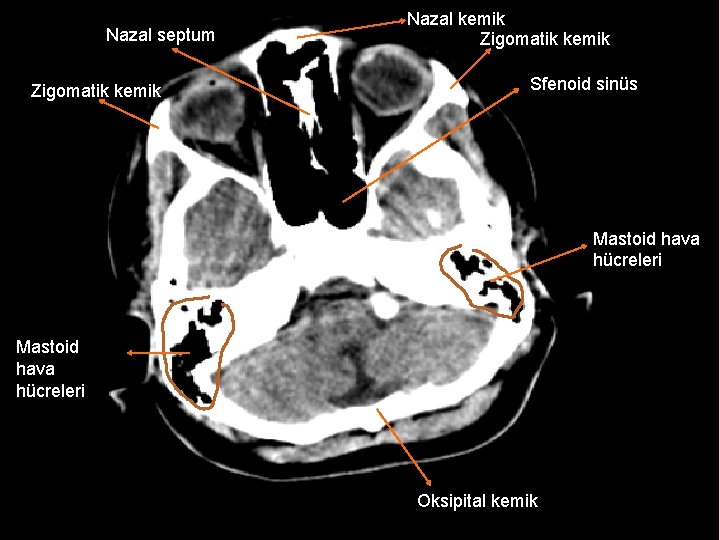 Nazal septum Zigomatik kemik Nazal kemik Zigomatik kemik Sfenoid sinüs Mastoid hava hücreleri Oksipital