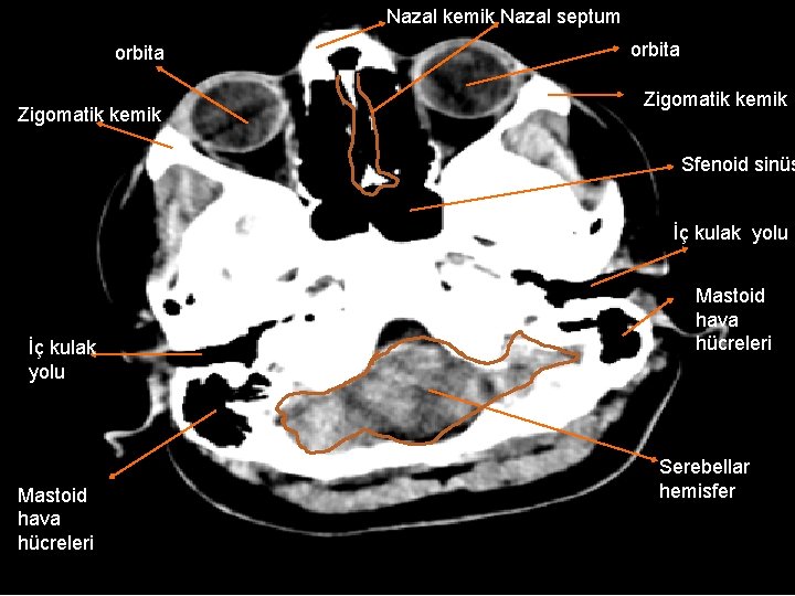 Nazal kemik Nazal septum orbita Zigomatik kemik Sfenoid sinüs İç kulak yolu İç kulak