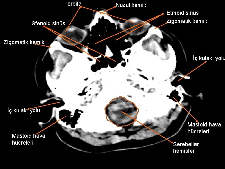 orbita Sfenoid sinüs Nazal kemik Etmoid sinüs Zigomatik kemik İç kulak yolu Mastoid hava