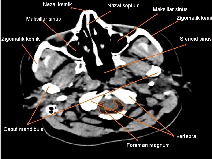 Nazal kemik Nazal septum Maksillar sinüs Zigomatik kemi Maksillar sinüs Sfenoid sinüs Zigomatik kemik