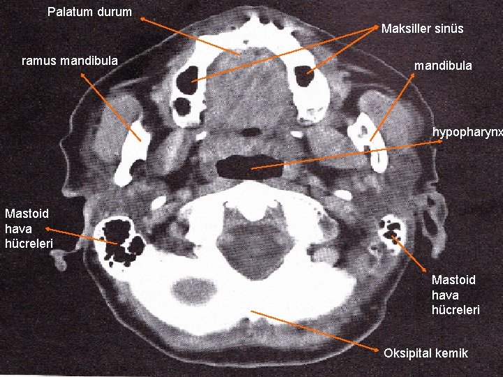 Palatum durum Maksiller sinüs ramus mandibula hypopharynx Mastoid hava hücreleri Oksipital kemik 