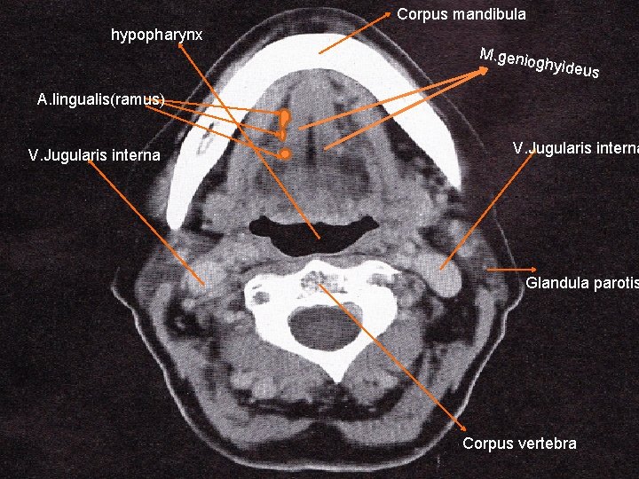 Corpus mandibula hypopharynx M. genio ghyideu s A. lingualis(ramus) V. Jugularis interna Glandula parotis