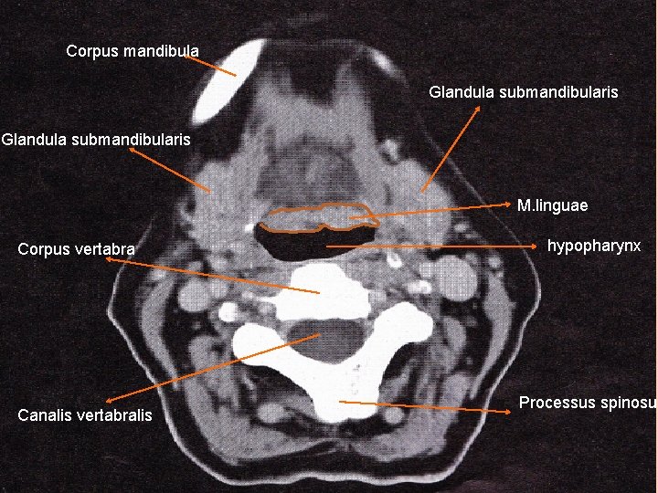 Corpus mandibula Glandula submandibularis M. linguae Corpus vertabra Canalis vertabralis hypopharynx Processus spinosus 