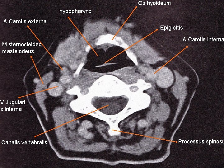 Os hyoideum hypopharynx A. Carotis externa Epiglottis M. sternocleideo masteiodeus A. Carotis interna V.