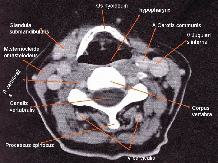 Os hyoideum Glandula submandibularis hypopharynx A. Carotis communis V. Jugulari s interna s A.