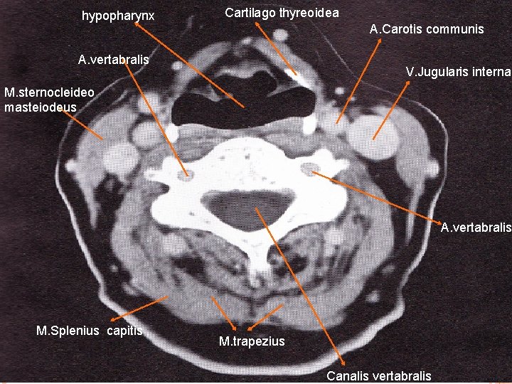 hypopharynx Cartilago thyreoidea A. Carotis communis A. vertabralis V. Jugularis interna M. sternocleideo masteiodeus