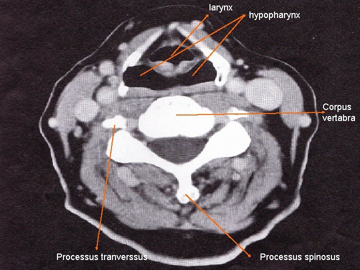 larynx hypopharynx Corpus vertabra Processus tranverssus Processus spinosus 