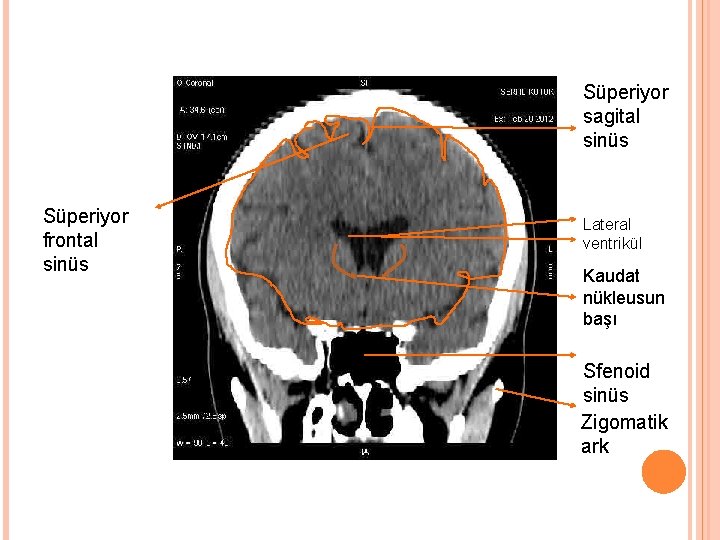 Süperiyor sagital sinüs Süperiyor frontal sinüs Lateral ventrikül Kaudat nükleusun başı Sfenoid sinüs Zigomatik