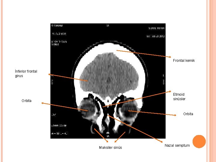 Frontal kemik İnferior frontal girus Etmoid sinüsler Orbita Maksiler sinüs Nazal semptum 