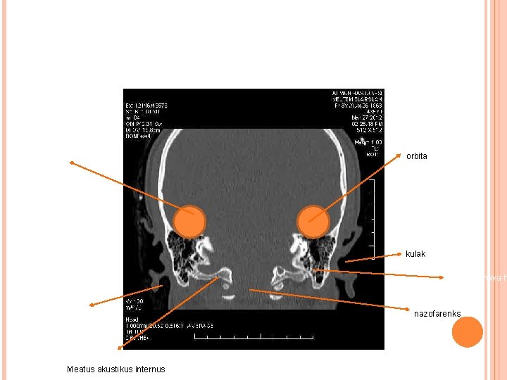 orbita kulak Mastoid hava h Kulak Meatus akustıkus internus nazofarenks 