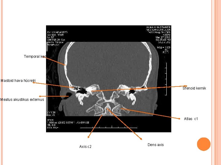 Temporal kemik Mastoid hava hücrelri Sfenoid kemik Meatus akustikus externus Atlas c 1 Axis