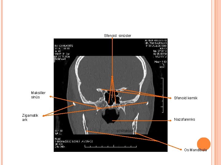 Sfenoid sinüsler Maksiller sinüs Zigamatik ark Sfenoid kemik Nazofarenks Os Mandibula 