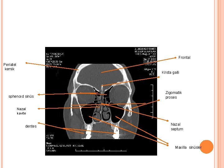 Frontal Periatel kemik Krista galli sphenoıd sinüs Zigomatik proses Nazal kavite dentes Nazal septum