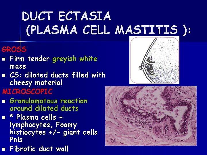 DUCT ECTASIA (PLASMA CELL MASTITIS ): GROSS n Firm tender greyish white mass n