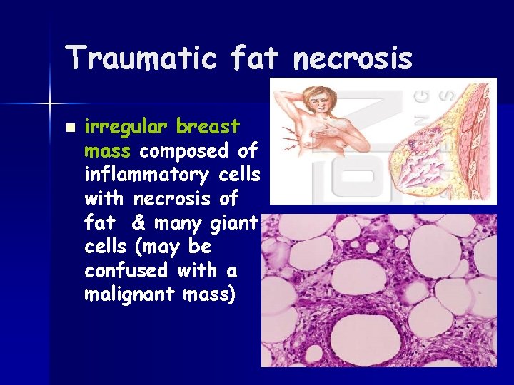 Traumatic fat necrosis n irregular breast mass composed of inflammatory cells with necrosis of