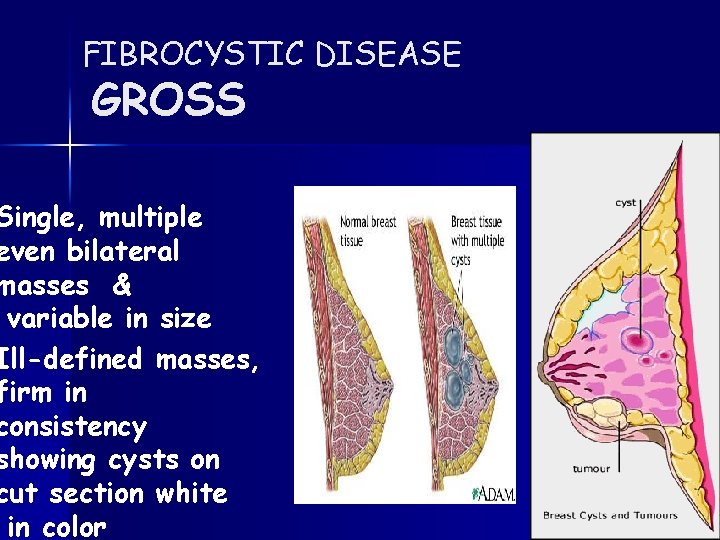 FIBROCYSTIC DISEASE GROSS Single, multiple even bilateral masses & variable in size Ill-defined masses,