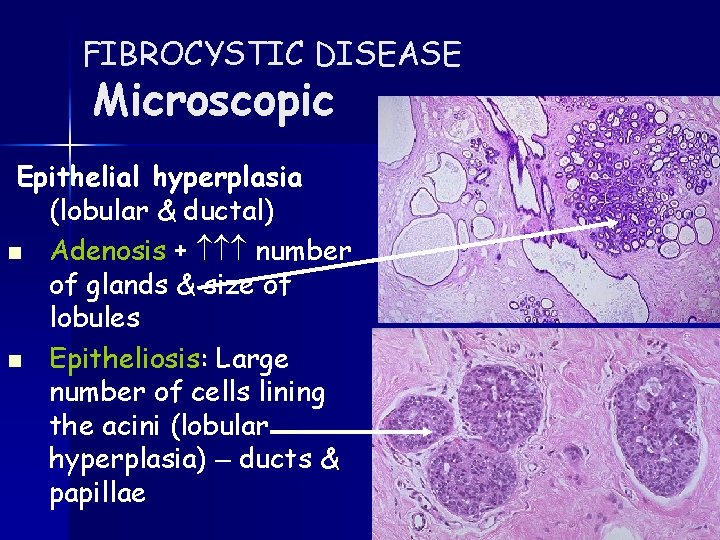 FIBROCYSTIC DISEASE Microscopic Epithelial hyperplasia (lobular & ductal) n Adenosis + number of glands