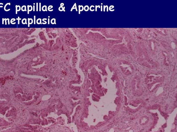 FC papillae & Apocrine metaplasia 