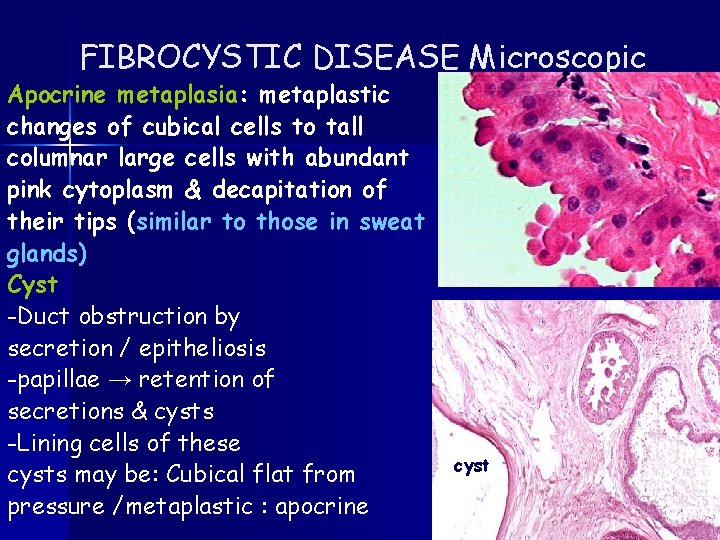 FIBROCYSTIC DISEASE Microscopic Apocrine metaplasia: metaplastic changes of cubical cells to tall columnar large