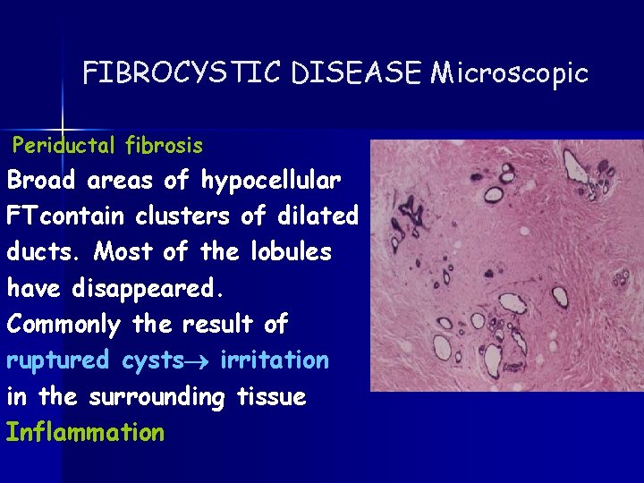 FIBROCYSTIC DISEASE Microscopic Periductal fibrosis Broad areas of hypocellular FTcontain clusters of dilated ducts.