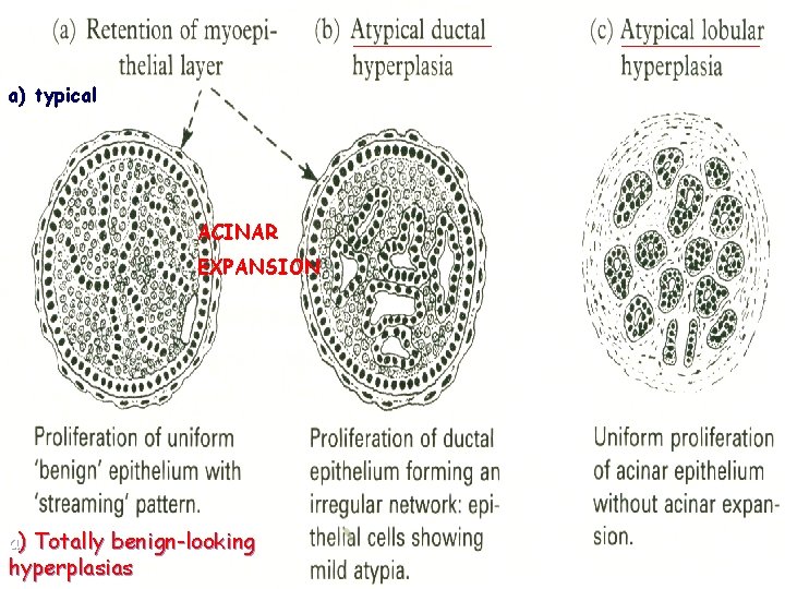 a) typical ACINAR EXPANSION a) Totally benign-looking hyperplasias 