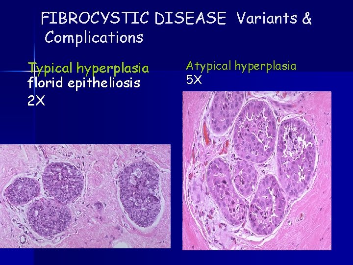 FIBROCYSTIC DISEASE Variants & Complications Typical hyperplasia florid epitheliosis 2 X Atypical hyperplasia 5