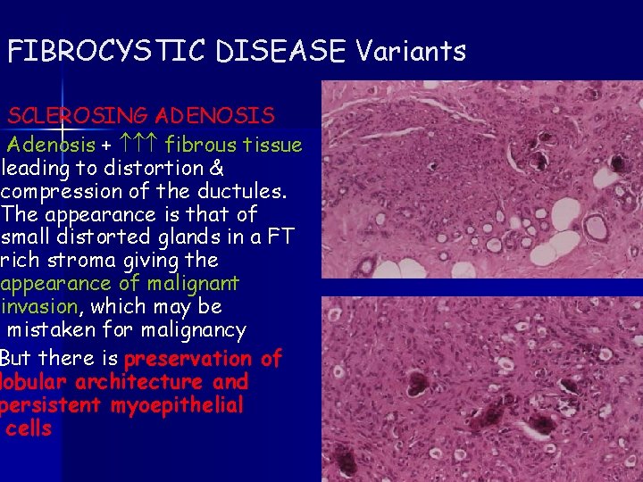 FIBROCYSTIC DISEASE Variants SCLEROSING ADENOSIS Adenosis + fibrous tissue leading to distortion & compression