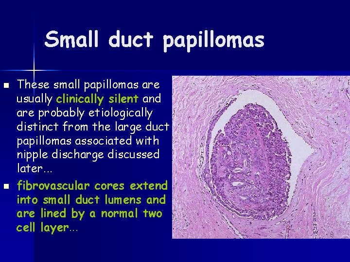 Small duct papillomas n n These small papillomas are usually clinically silent and are