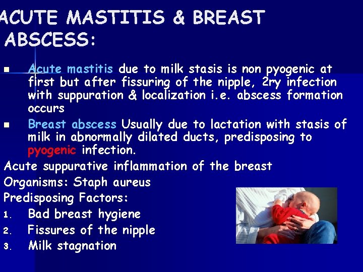 ACUTE MASTITIS & BREAST ABSCESS: Acute mastitis due to milk stasis is non pyogenic