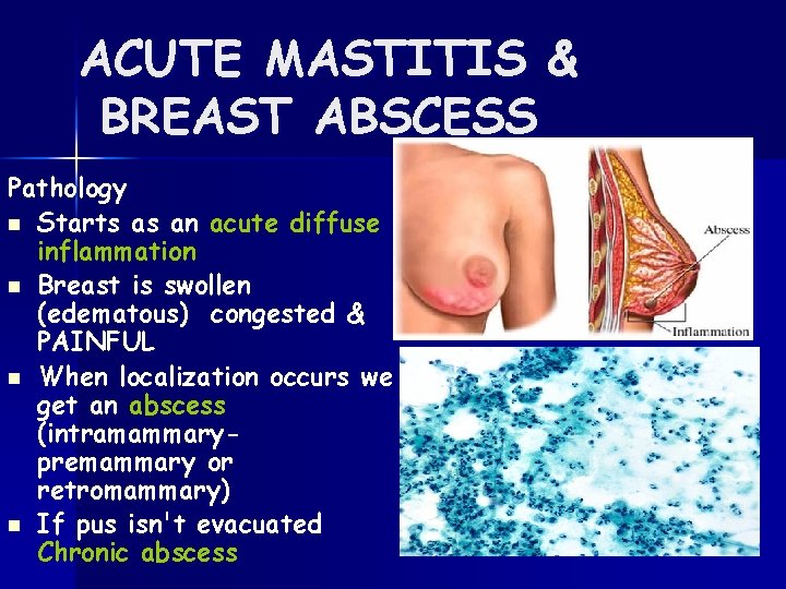 ACUTE MASTITIS & BREAST ABSCESS Pathology n Starts as an acute diffuse inflammation n