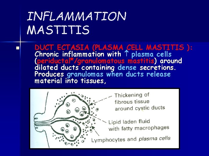 INFLAMMATION MASTITIS n DUCT ECTASIA (PLASMA CELL MASTITIS ): Chronic inflammation with plasma cells