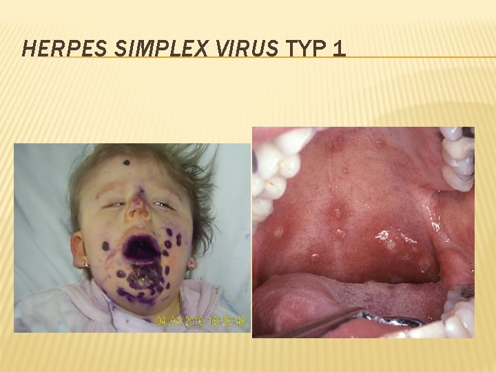 HERPES SIMPLEX VIRUS TYP 1 