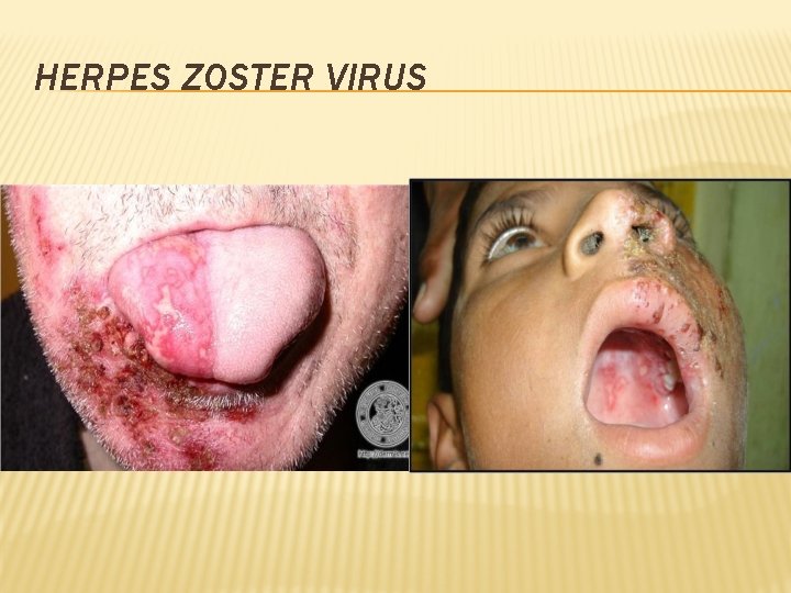 HERPES ZOSTER VIRUS 