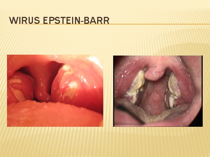 WIRUS EPSTEIN-BARR 