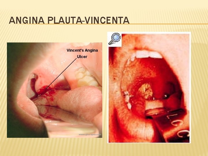 ANGINA PLAUTA-VINCENTA 