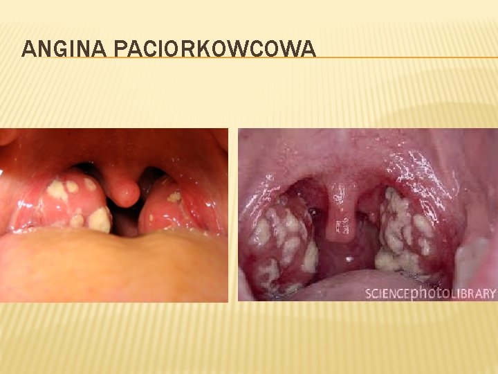 ANGINA PACIORKOWCOWA 