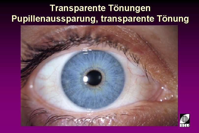 Transparente Tönungen Pupillenaussparung, transparente Tönung 97711 -22 S. PPT 