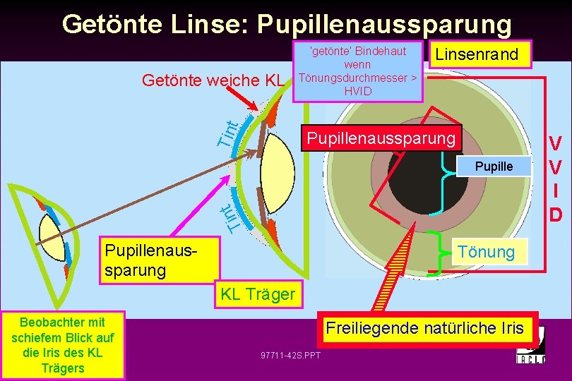 Getönte Linse: Pupillenaussparung Linsenrand Tin t Getönte weiche KL ‘getönte’ Bindehaut wenn Tönungsdurchmesser >
