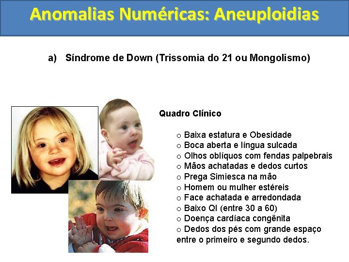 Anomalias Numéricas: Aneuploidias a) Síndrome de Down (Trissomia do 21 ou Mongolismo) Quadro Clínico